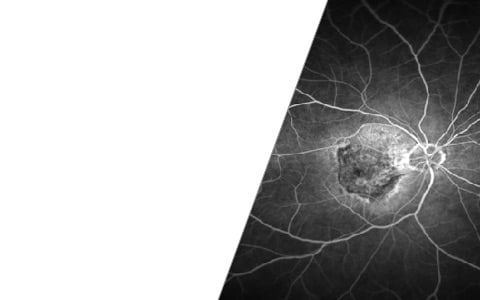 What is Age-Related Macular Degeneration?